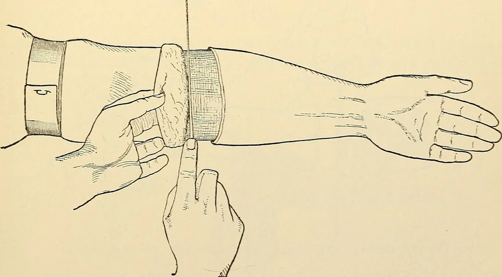 An illustration from Surgical technic; a text-book on operative surgery / by Fr. von Esmarch ... and E. Kowalzig ... translated by Professor Ludwig H. Grau ... and Willam N. Sullivan ... edited by Nicholas Senn ... With fourteen hundred and ninety-seven illustrations and fifteen colored plates., 1901, leaf 385