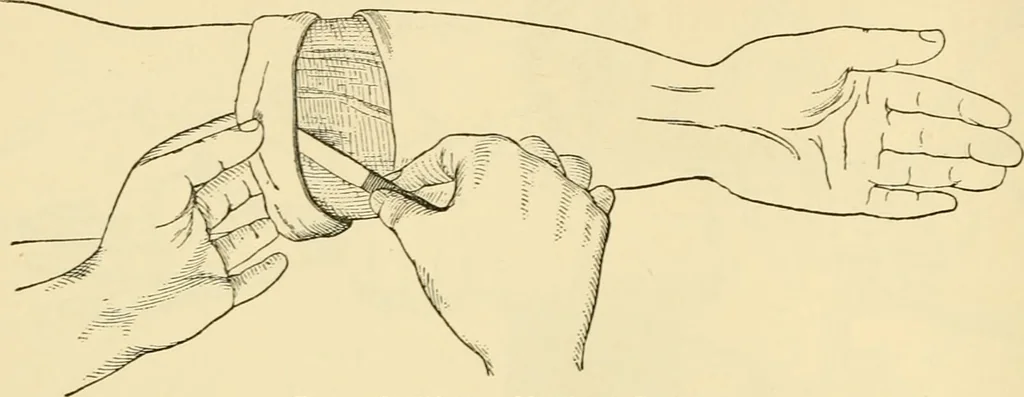 An illustration from Surgical technic; a text-book on operative surgery / by Fr. von Esmarch ... and E. Kowalzig ... translated by Professor Ludwig H. Grau ... and Willam N. Sullivan ... edited by Nicholas Senn ... With fourteen hundred and ninety-seven illustrations and fifteen colored plates., 1901, leaf 386