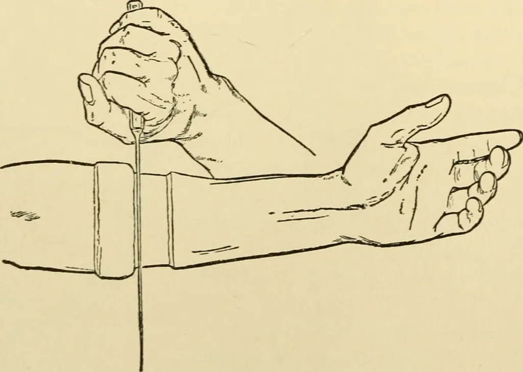 An illustration from Surgical technic; a text-book on operative surgery / by Fr. von Esmarch ... and E. Kowalzig ... translated by Professor Ludwig H. Grau ... and Willam N. Sullivan ... edited by Nicholas Senn ... With fourteen hundred and ninety-seven illustrations and fifteen colored plates., 1901, leaf 386