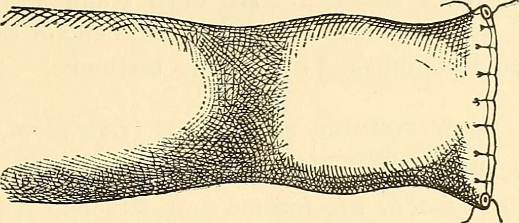 An illustration from Surgical technic; a text-book on operative surgery / by Fr. von Esmarch ... and E. Kowalzig ... translated by Professor Ludwig H. Grau ... and Willam N. Sullivan ... edited by Nicholas Senn ... With fourteen hundred and ninety-seven illustrations and fifteen colored plates., 1901, leaf 387