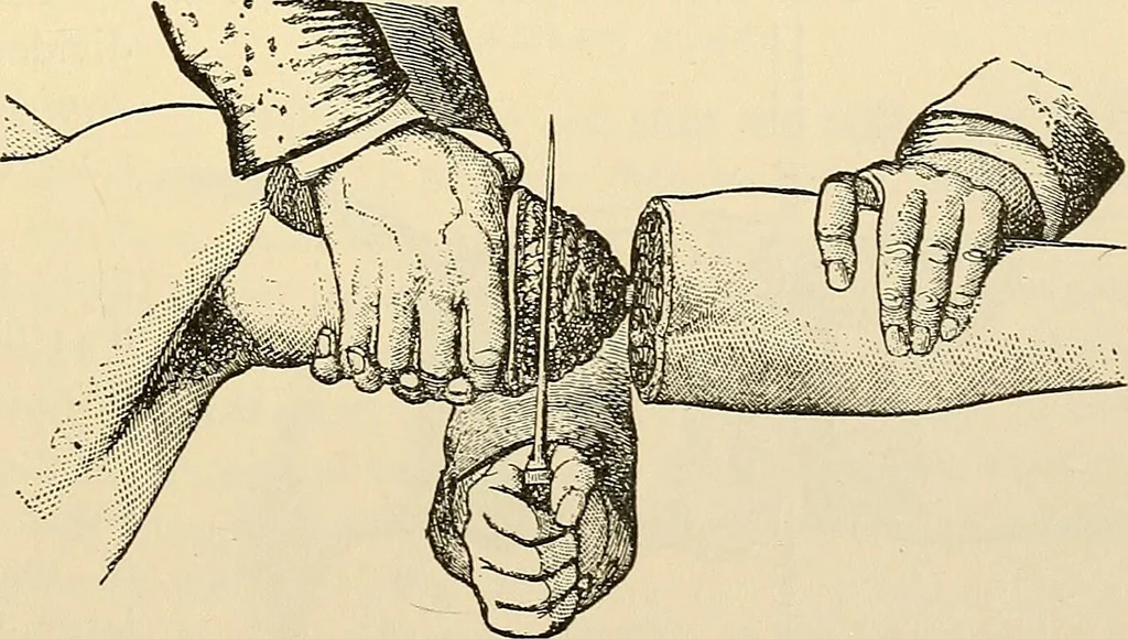 An illustration from Surgical technic; a text-book on operative surgery / by Fr. von Esmarch ... and E. Kowalzig ... translated by Professor Ludwig H. Grau ... and Willam N. Sullivan ... edited by Nicholas Senn ... With fourteen hundred and ninety-seven illustrations and fifteen colored plates., 1901, leaf 387