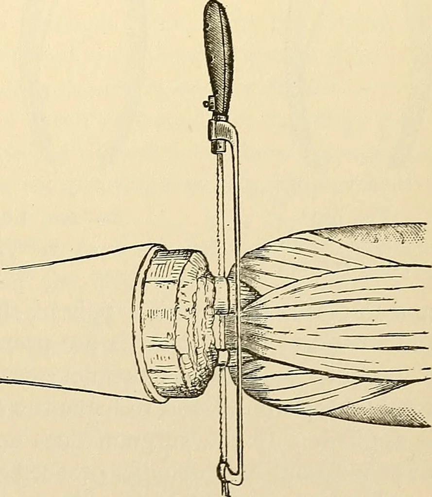 An illustration from Surgical technic; a text-book on operative surgery / by Fr. von Esmarch ... and E. Kowalzig ... translated by Professor Ludwig H. Grau ... and Willam N. Sullivan ... edited by Nicholas Senn ... With fourteen hundred and ninety-seven illustrations and fifteen colored plates., 1901, leaf 393
