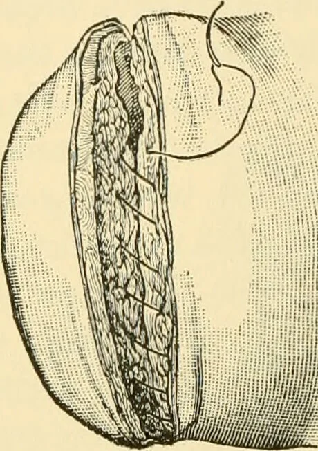 An illustration from Surgical technic; a text-book on operative surgery / by Fr. von Esmarch ... and E. Kowalzig ... translated by Professor Ludwig H. Grau ... and Willam N. Sullivan ... edited by Nicholas Senn ... With fourteen hundred and ninety-seven illustrations and fifteen colored plates., 1901, leaf 396