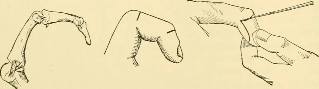 An illustration from Surgical technic; a text-book on operative surgery / by Fr. von Esmarch ... and E. Kowalzig ... translated by Professor Ludwig H. Grau ... and Willam N. Sullivan ... edited by Nicholas Senn ... With fourteen hundred and ninety-seven illustrations and fifteen colored plates., 1901, leaf 400