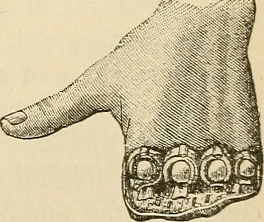 An illustration from Surgical technic; a text-book on operative surgery / by Fr. von Esmarch ... and E. Kowalzig ... translated by Professor Ludwig H. Grau ... and Willam N. Sullivan ... edited by Nicholas Senn ... With fourteen hundred and ninety-seven illustrations and fifteen colored plates., 1901, leaf 403