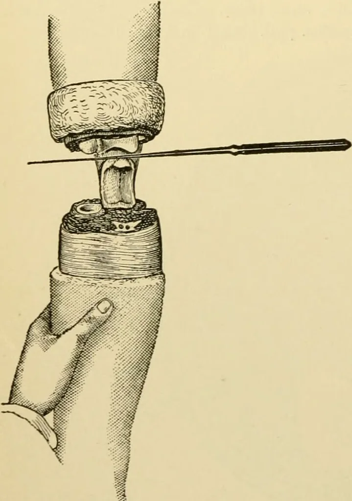 An illustration from Surgical technic; a text-book on operative surgery / by Fr. von Esmarch ... and E. Kowalzig ... translated by Professor Ludwig H. Grau ... and Willam N. Sullivan ... edited by Nicholas Senn ... With fourteen hundred and ninety-seven illustrations and fifteen colored plates., 1901, leaf 412
