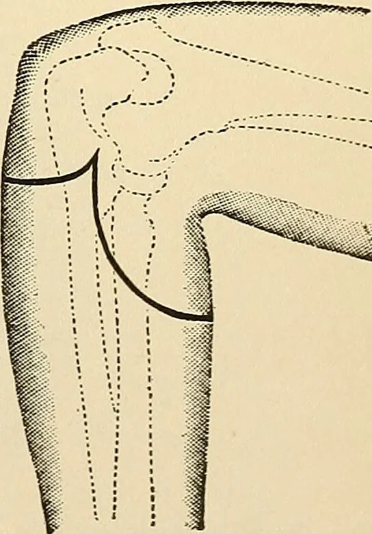 An illustration from Surgical technic; a text-book on operative surgery / by Fr. von Esmarch ... and E. Kowalzig ... translated by Professor Ludwig H. Grau ... and Willam N. Sullivan ... edited by Nicholas Senn ... With fourteen hundred and ninety-seven illustrations and fifteen colored plates., 1901, leaf 415