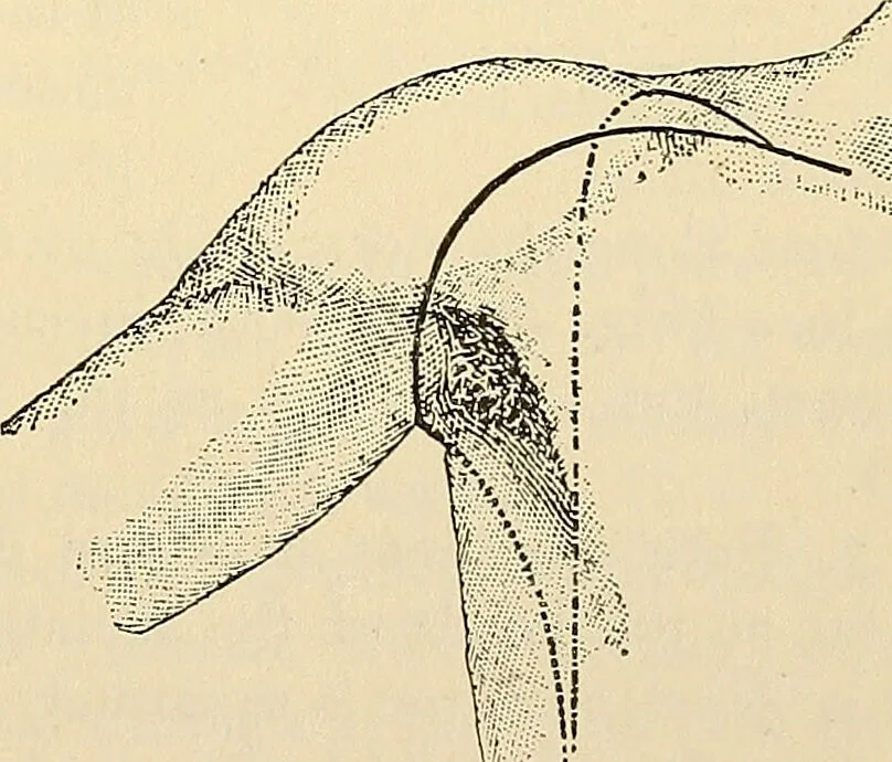 An illustration from Surgical technic; a text-book on operative surgery / by Fr. von Esmarch ... and E. Kowalzig ... translated by Professor Ludwig H. Grau ... and Willam N. Sullivan ... edited by Nicholas Senn ... With fourteen hundred and ninety-seven illustrations and fifteen colored plates., 1901, leaf 423