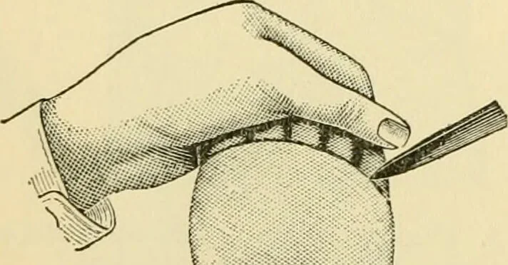 An illustration from Surgical technic; a text-book on operative surgery / by Fr. von Esmarch ... and E. Kowalzig ... translated by Professor Ludwig H. Grau ... and Willam N. Sullivan ... edited by Nicholas Senn ... With fourteen hundred and ninety-seven illustrations and fifteen colored plates., 1901, leaf 424