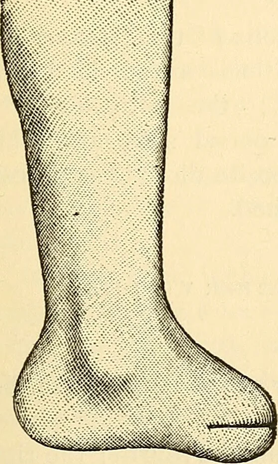 An illustration from Surgical technic; a text-book on operative surgery / by Fr. von Esmarch ... and E. Kowalzig ... translated by Professor Ludwig H. Grau ... and Willam N. Sullivan ... edited by Nicholas Senn ... With fourteen hundred and ninety-seven illustrations and fifteen colored plates., 1901, leaf 425