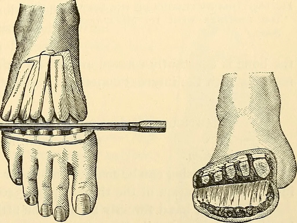An illustration from Surgical technic; a text-book on operative surgery / by Fr. von Esmarch ... and E. Kowalzig ... translated by Professor Ludwig H. Grau ... and Willam N. Sullivan ... edited by Nicholas Senn ... With fourteen hundred and ninety-seven illustrations and fifteen colored plates., 1901, leaf 425