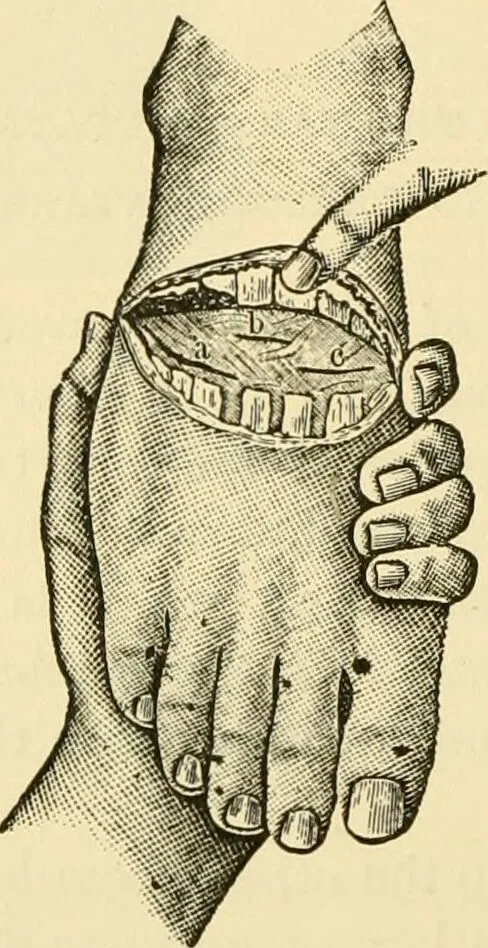An illustration from Surgical technic; a text-book on operative surgery / by Fr. von Esmarch ... and E. Kowalzig ... translated by Professor Ludwig H. Grau ... and Willam N. Sullivan ... edited by Nicholas Senn ... With fourteen hundred and ninety-seven illustrations and fifteen colored plates., 1901, leaf 428