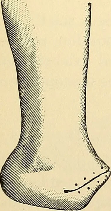 An illustration from Surgical technic; a text-book on operative surgery / by Fr. von Esmarch ... and E. Kowalzig ... translated by Professor Ludwig H. Grau ... and Willam N. Sullivan ... edited by Nicholas Senn ... With fourteen hundred and ninety-seven illustrations and fifteen colored plates., 1901, leaf 431
