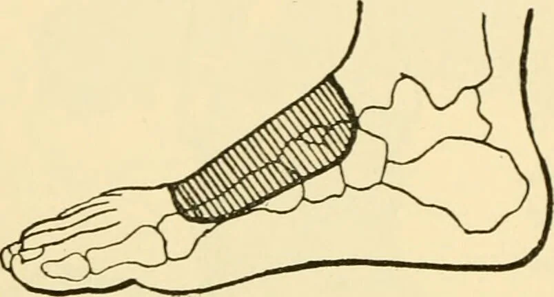 An illustration from Surgical technic; a text-book on operative surgery / by Fr. von Esmarch ... and E. Kowalzig ... translated by Professor Ludwig H. Grau ... and Willam N. Sullivan ... edited by Nicholas Senn ... With fourteen hundred and ninety-seven illustrations and fifteen colored plates., 1901, leaf 432
