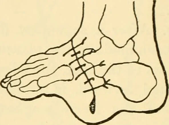 An illustration from Surgical technic; a text-book on operative surgery / by Fr. von Esmarch ... and E. Kowalzig ... translated by Professor Ludwig H. Grau ... and Willam N. Sullivan ... edited by Nicholas Senn ... With fourteen hundred and ninety-seven illustrations and fifteen colored plates., 1901, leaf 432