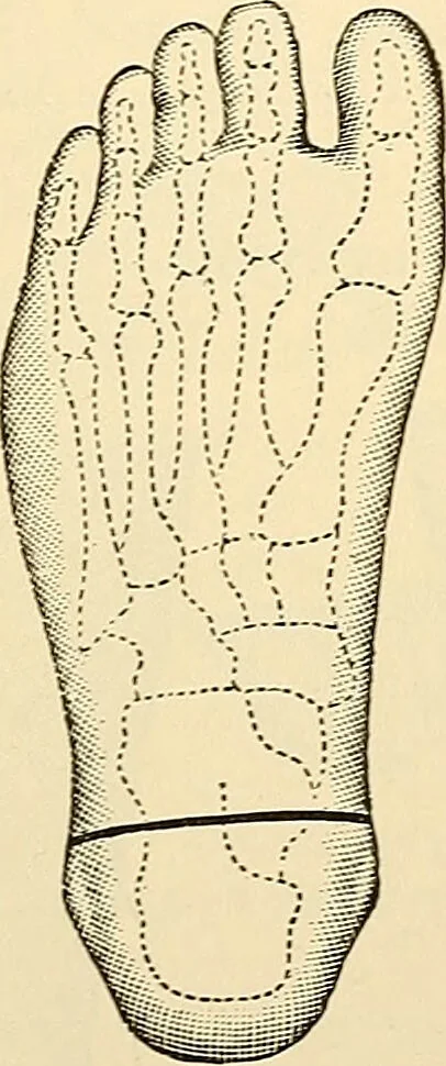 An illustration from Surgical technic; a text-book on operative surgery / by Fr. von Esmarch ... and E. Kowalzig ... translated by Professor Ludwig H. Grau ... and Willam N. Sullivan ... edited by Nicholas Senn ... With fourteen hundred and ninety-seven illustrations and fifteen colored plates., 1901, leaf 435
