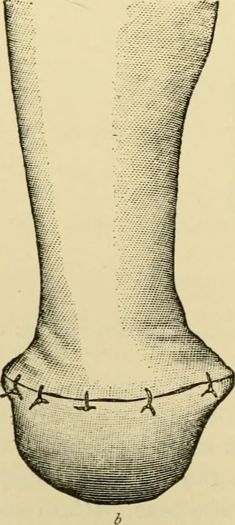 An illustration from Surgical technic; a text-book on operative surgery / by Fr. von Esmarch ... and E. Kowalzig ... translated by Professor Ludwig H. Grau ... and Willam N. Sullivan ... edited by Nicholas Senn ... With fourteen hundred and ninety-seven illustrations and fifteen colored plates., 1901, leaf 436