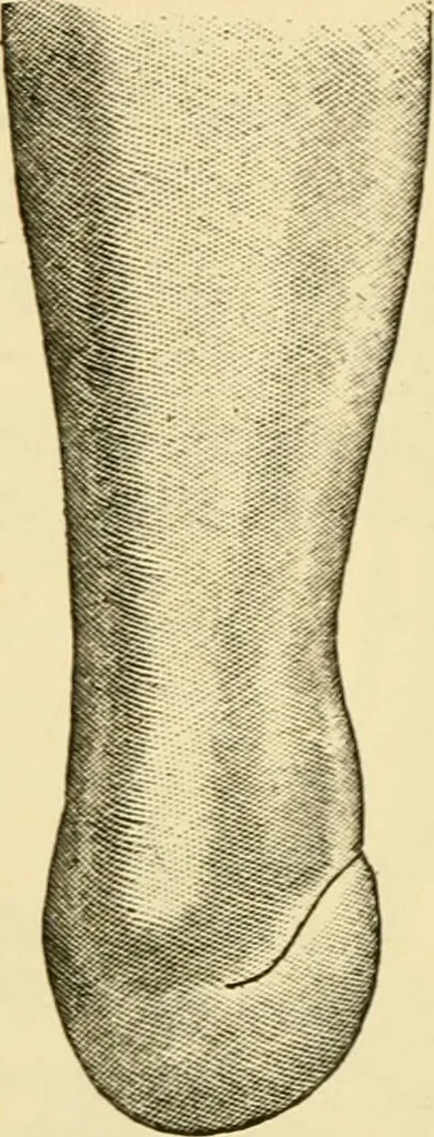 An illustration from Surgical technic; a text-book on operative surgery / by Fr. von Esmarch ... and E. Kowalzig ... translated by Professor Ludwig H. Grau ... and Willam N. Sullivan ... edited by Nicholas Senn ... With fourteen hundred and ninety-seven illustrations and fifteen colored plates., 1901, leaf 438
