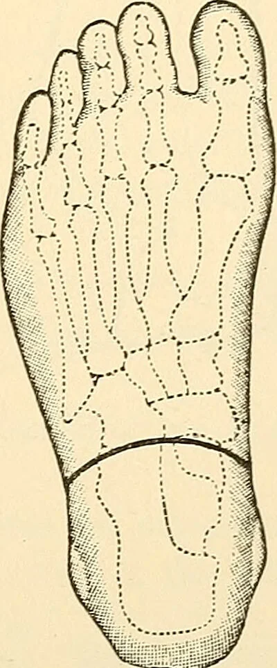 An illustration from Surgical technic; a text-book on operative surgery / by Fr. von Esmarch ... and E. Kowalzig ... translated by Professor Ludwig H. Grau ... and Willam N. Sullivan ... edited by Nicholas Senn ... With fourteen hundred and ninety-seven illustrations and fifteen colored plates., 1901, leaf 439