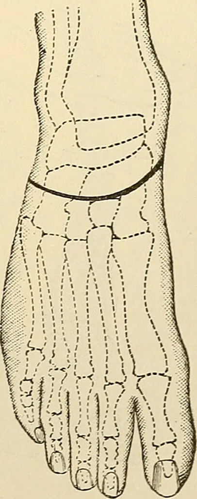 An illustration from Surgical technic; a text-book on operative surgery / by Fr. von Esmarch ... and E. Kowalzig ... translated by Professor Ludwig H. Grau ... and Willam N. Sullivan ... edited by Nicholas Senn ... With fourteen hundred and ninety-seven illustrations and fifteen colored plates., 1901, leaf 439