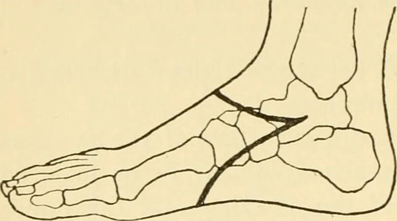 An illustration from Surgical technic; a text-book on operative surgery / by Fr. von Esmarch ... and E. Kowalzig ... translated by Professor Ludwig H. Grau ... and Willam N. Sullivan ... edited by Nicholas Senn ... With fourteen hundred and ninety-seven illustrations and fifteen colored plates., 1901, leaf 442