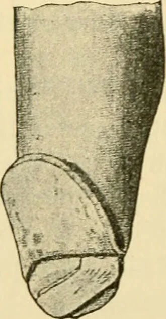 An illustration from Surgical technic; a text-book on operative surgery / by Fr. von Esmarch ... and E. Kowalzig ... translated by Professor Ludwig H. Grau ... and Willam N. Sullivan ... edited by Nicholas Senn ... With fourteen hundred and ninety-seven illustrations and fifteen colored plates., 1901, leaf 444