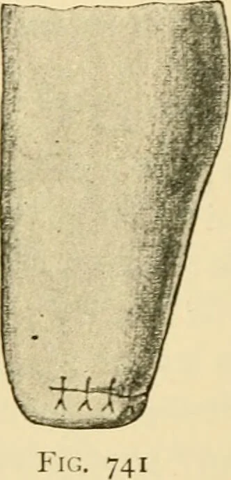 An illustration from Surgical technic; a text-book on operative surgery / by Fr. von Esmarch ... and E. Kowalzig ... translated by Professor Ludwig H. Grau ... and Willam N. Sullivan ... edited by Nicholas Senn ... With fourteen hundred and ninety-seven illustrations and fifteen colored plates., 1901, leaf 444