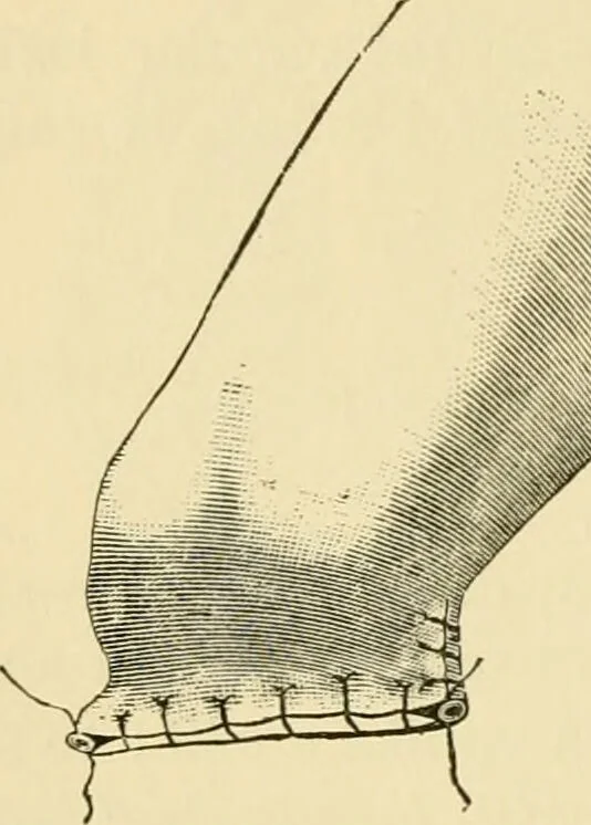 An illustration from Surgical technic; a text-book on operative surgery / by Fr. von Esmarch ... and E. Kowalzig ... translated by Professor Ludwig H. Grau ... and Willam N. Sullivan ... edited by Nicholas Senn ... With fourteen hundred and ninety-seven illustrations and fifteen colored plates., 1901, leaf 450