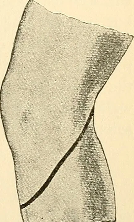 An illustration from Surgical technic; a text-book on operative surgery / by Fr. von Esmarch ... and E. Kowalzig ... translated by Professor Ludwig H. Grau ... and Willam N. Sullivan ... edited by Nicholas Senn ... With fourteen hundred and ninety-seven illustrations and fifteen colored plates., 1901, leaf 451