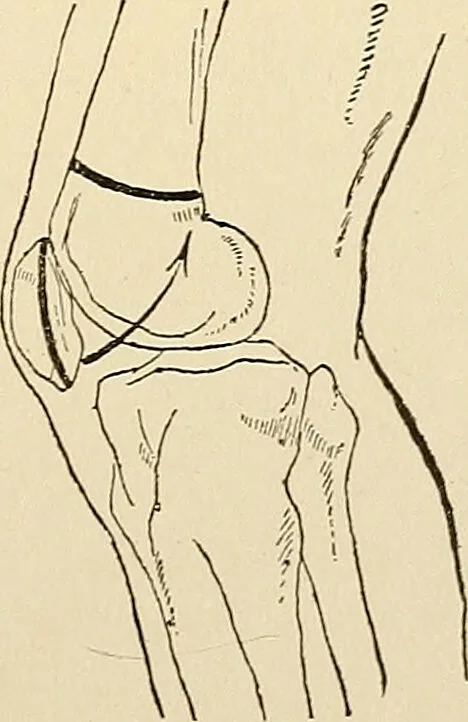 An illustration from Surgical technic; a text-book on operative surgery / by Fr. von Esmarch ... and E. Kowalzig ... translated by Professor Ludwig H. Grau ... and Willam N. Sullivan ... edited by Nicholas Senn ... With fourteen hundred and ninety-seven illustrations and fifteen colored plates., 1901, leaf 451