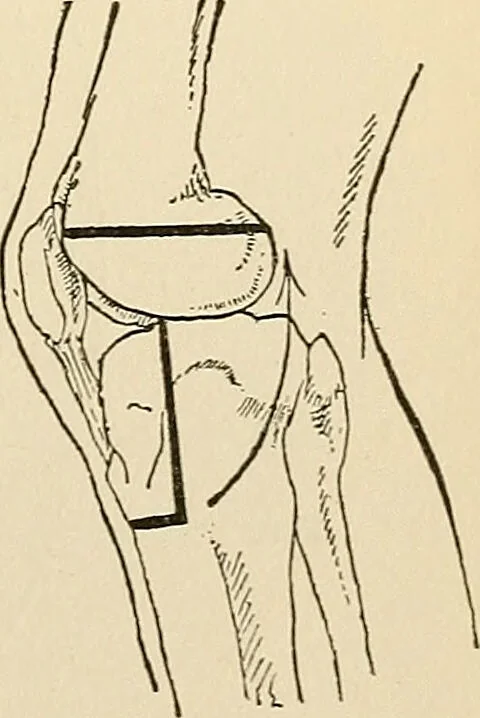 An illustration from Surgical technic; a text-book on operative surgery / by Fr. von Esmarch ... and E. Kowalzig ... translated by Professor Ludwig H. Grau ... and Willam N. Sullivan ... edited by Nicholas Senn ... With fourteen hundred and ninety-seven illustrations and fifteen colored plates., 1901, leaf 451