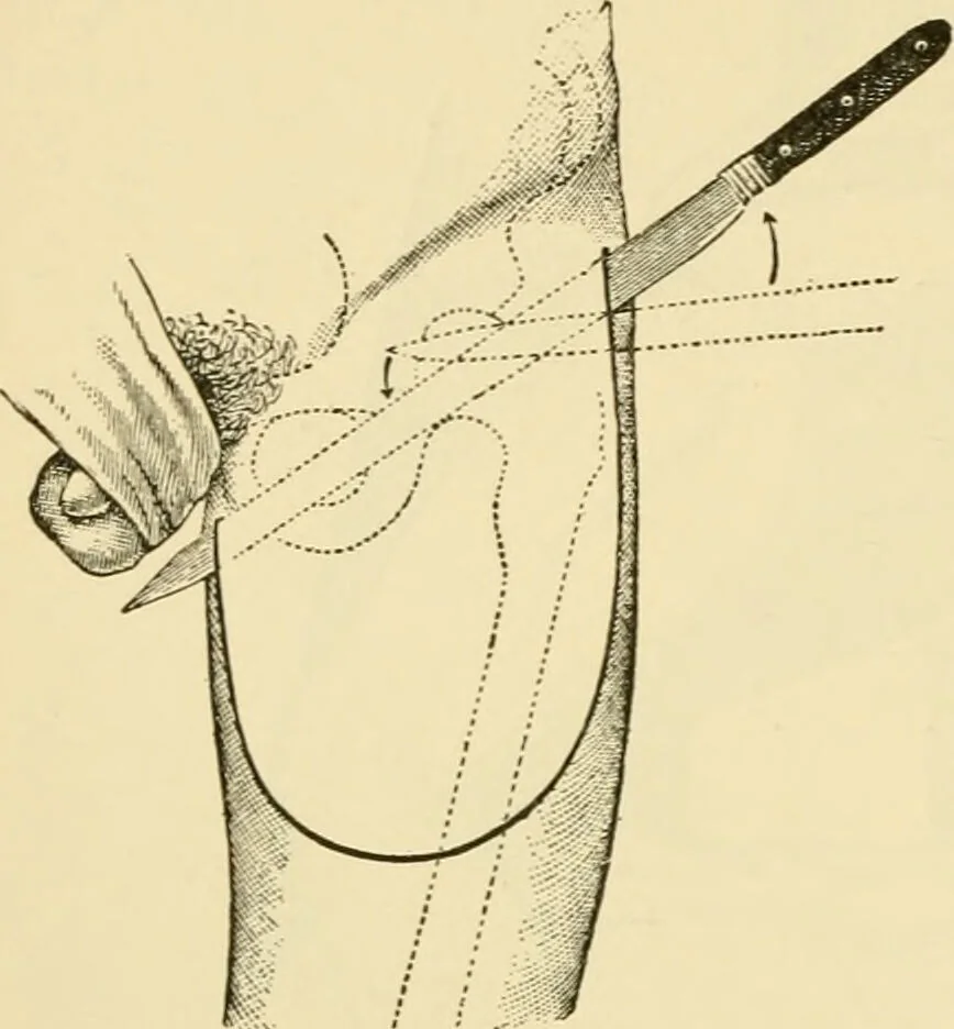 An illustration from Surgical technic; a text-book on operative surgery / by Fr. von Esmarch ... and E. Kowalzig ... translated by Professor Ludwig H. Grau ... and Willam N. Sullivan ... edited by Nicholas Senn ... With fourteen hundred and ninety-seven illustrations and fifteen colored plates., 1901, leaf 460