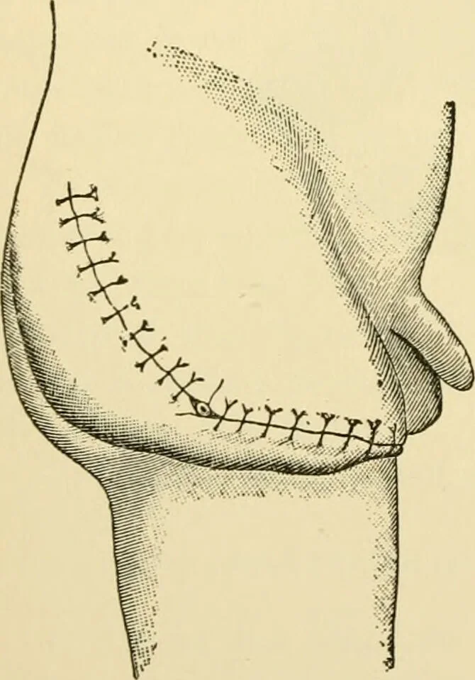 An illustration from Surgical technic; a text-book on operative surgery / by Fr. von Esmarch ... and E. Kowalzig ... translated by Professor Ludwig H. Grau ... and Willam N. Sullivan ... edited by Nicholas Senn ... With fourteen hundred and ninety-seven illustrations and fifteen colored plates., 1901, leaf 464