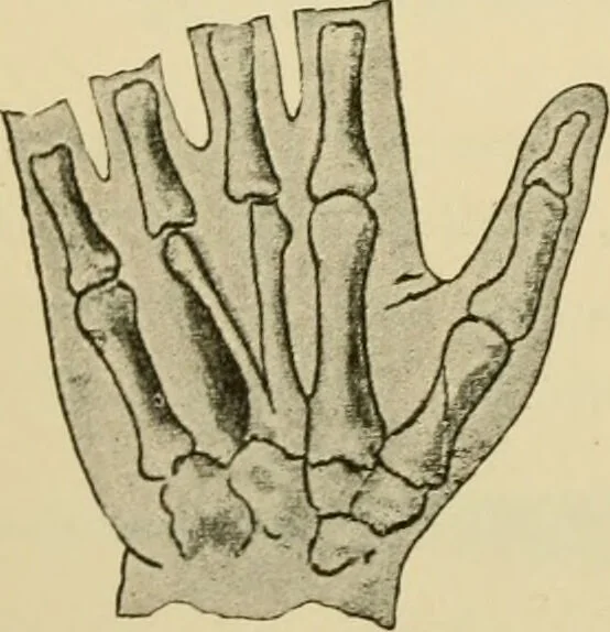 An illustration from Surgical technic; a text-book on operative surgery / by Fr. von Esmarch ... and E. Kowalzig ... translated by Professor Ludwig H. Grau ... and Willam N. Sullivan ... edited by Nicholas Senn ... With fourteen hundred and ninety-seven illustrations and fifteen colored plates., 1901, leaf 470
