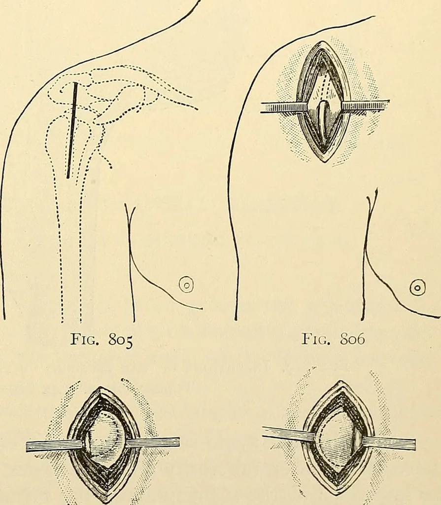 An illustration from Surgical technic; a text-book on operative surgery / by Fr. von Esmarch ... and E. Kowalzig ... translated by Professor Ludwig H. Grau ... and Willam N. Sullivan ... edited by Nicholas Senn ... With fourteen hundred and ninety-seven illustrations and fifteen colored plates., 1901, leaf 487