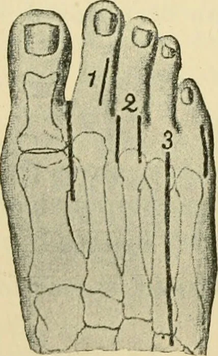An illustration from Surgical technic; a text-book on operative surgery / by Fr. von Esmarch ... and E. Kowalzig ... translated by Professor Ludwig H. Grau ... and Willam N. Sullivan ... edited by Nicholas Senn ... With fourteen hundred and ninety-seven illustrations and fifteen colored plates., 1901, leaf 496