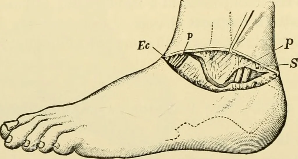 An illustration from Surgical technic; a text-book on operative surgery / by Fr. von Esmarch ... and E. Kowalzig ... translated by Professor Ludwig H. Grau ... and Willam N. Sullivan ... edited by Nicholas Senn ... With fourteen hundred and ninety-seven illustrations and fifteen colored plates., 1901, leaf 502