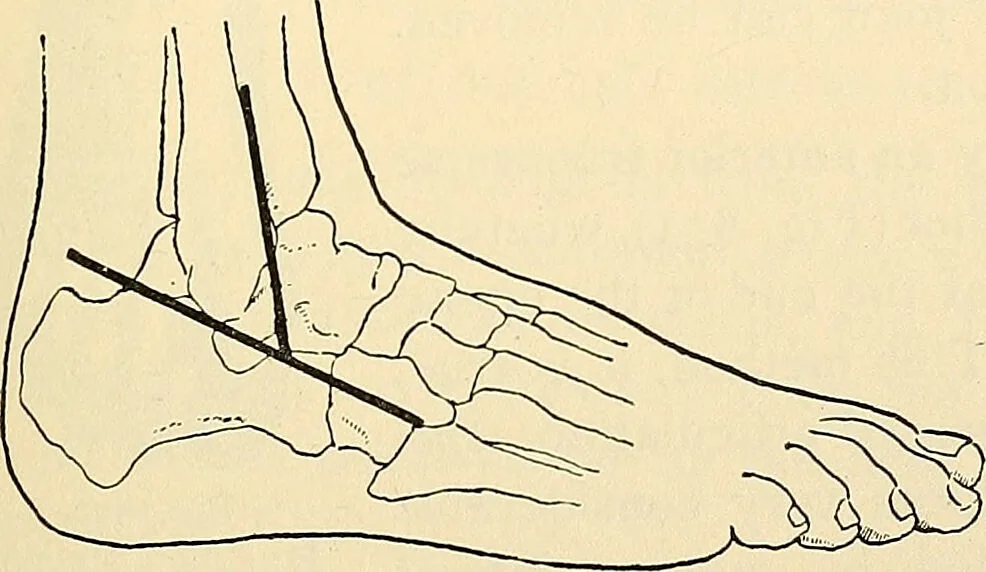 An illustration from Surgical technic; a text-book on operative surgery / by Fr. von Esmarch ... and E. Kowalzig ... translated by Professor Ludwig H. Grau ... and Willam N. Sullivan ... edited by Nicholas Senn ... With fourteen hundred and ninety-seven illustrations and fifteen colored plates., 1901, leaf 503