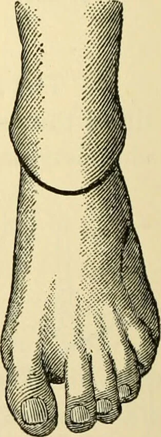 An illustration from Surgical technic; a text-book on operative surgery / by Fr. von Esmarch ... and E. Kowalzig ... translated by Professor Ludwig H. Grau ... and Willam N. Sullivan ... edited by Nicholas Senn ... With fourteen hundred and ninety-seven illustrations and fifteen colored plates., 1901, leaf 504