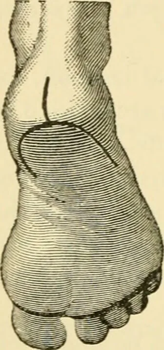 An illustration from Surgical technic; a text-book on operative surgery / by Fr. von Esmarch ... and E. Kowalzig ... translated by Professor Ludwig H. Grau ... and Willam N. Sullivan ... edited by Nicholas Senn ... With fourteen hundred and ninety-seven illustrations and fifteen colored plates., 1901, leaf 506