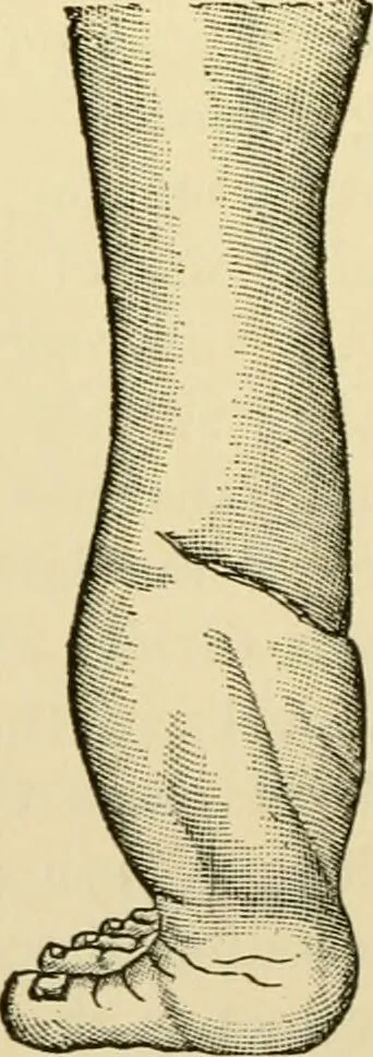 An illustration from Surgical technic; a text-book on operative surgery / by Fr. von Esmarch ... and E. Kowalzig ... translated by Professor Ludwig H. Grau ... and Willam N. Sullivan ... edited by Nicholas Senn ... With fourteen hundred and ninety-seven illustrations and fifteen colored plates., 1901, leaf 508