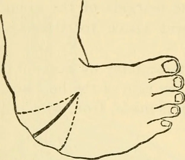 An illustration from Surgical technic; a text-book on operative surgery / by Fr. von Esmarch ... and E. Kowalzig ... translated by Professor Ludwig H. Grau ... and Willam N. Sullivan ... edited by Nicholas Senn ... With fourteen hundred and ninety-seven illustrations and fifteen colored plates., 1901, leaf 510