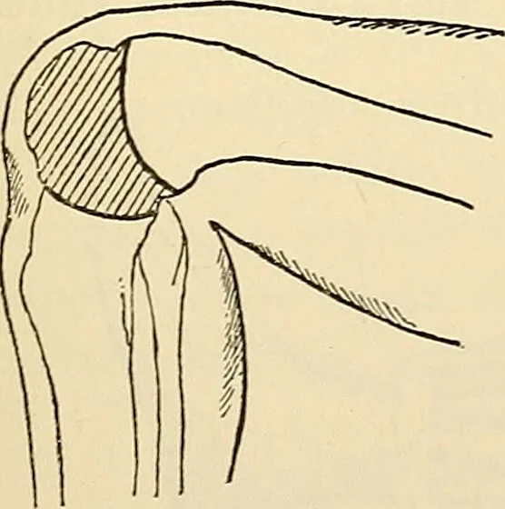 An illustration from Surgical technic; a text-book on operative surgery / by Fr. von Esmarch ... and E. Kowalzig ... translated by Professor Ludwig H. Grau ... and Willam N. Sullivan ... edited by Nicholas Senn ... With fourteen hundred and ninety-seven illustrations and fifteen colored plates., 1901, leaf 513
