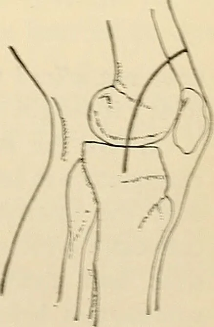 An illustration from Surgical technic; a text-book on operative surgery / by Fr. von Esmarch ... and E. Kowalzig ... translated by Professor Ludwig H. Grau ... and Willam N. Sullivan ... edited by Nicholas Senn ... With fourteen hundred and ninety-seven illustrations and fifteen colored plates., 1901, leaf 515
