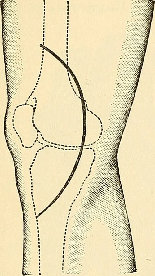An illustration from Surgical technic; a text-book on operative surgery / by Fr. von Esmarch ... and E. Kowalzig ... translated by Professor Ludwig H. Grau ... and Willam N. Sullivan ... edited by Nicholas Senn ... With fourteen hundred and ninety-seven illustrations and fifteen colored plates., 1901, leaf 517