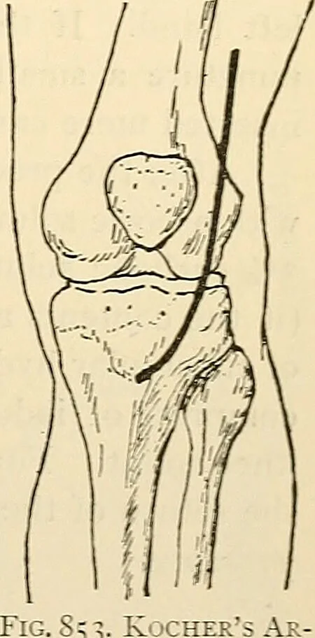 An illustration from Surgical technic; a text-book on operative surgery / by Fr. von Esmarch ... and E. Kowalzig ... translated by Professor Ludwig H. Grau ... and Willam N. Sullivan ... edited by Nicholas Senn ... With fourteen hundred and ninety-seven illustrations and fifteen colored plates., 1901, leaf 519