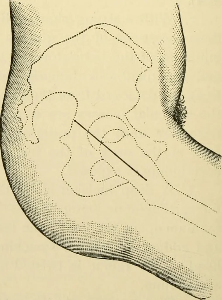 An illustration from Surgical technic; a text-book on operative surgery / by Fr. von Esmarch ... and E. Kowalzig ... translated by Professor Ludwig H. Grau ... and Willam N. Sullivan ... edited by Nicholas Senn ... With fourteen hundred and ninety-seven illustrations and fifteen colored plates., 1901, leaf 522