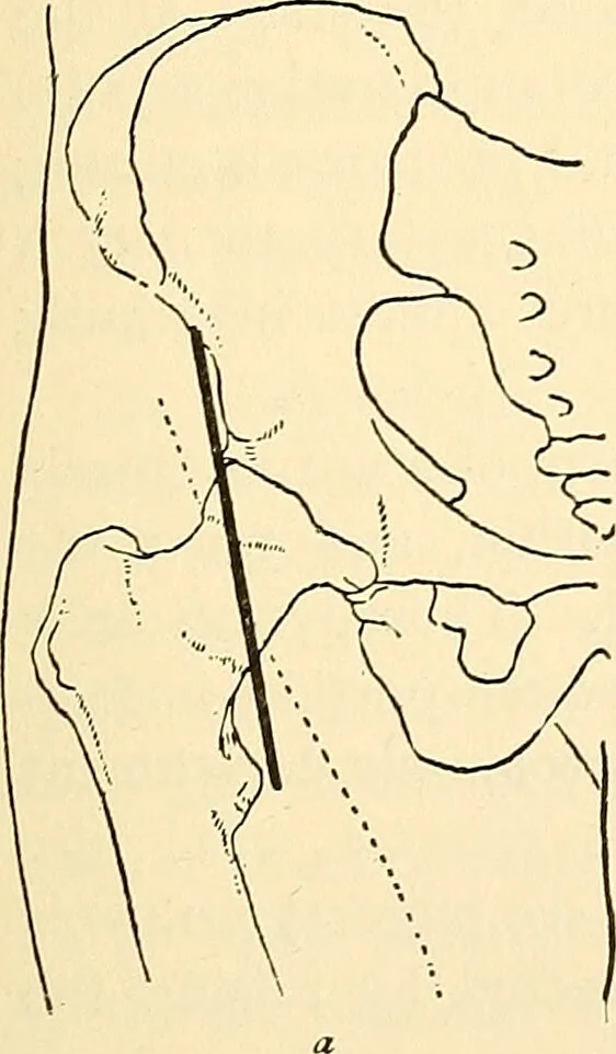 An illustration from Surgical technic; a text-book on operative surgery / by Fr. von Esmarch ... and E. Kowalzig ... translated by Professor Ludwig H. Grau ... and Willam N. Sullivan ... edited by Nicholas Senn ... With fourteen hundred and ninety-seven illustrations and fifteen colored plates., 1901, leaf 527