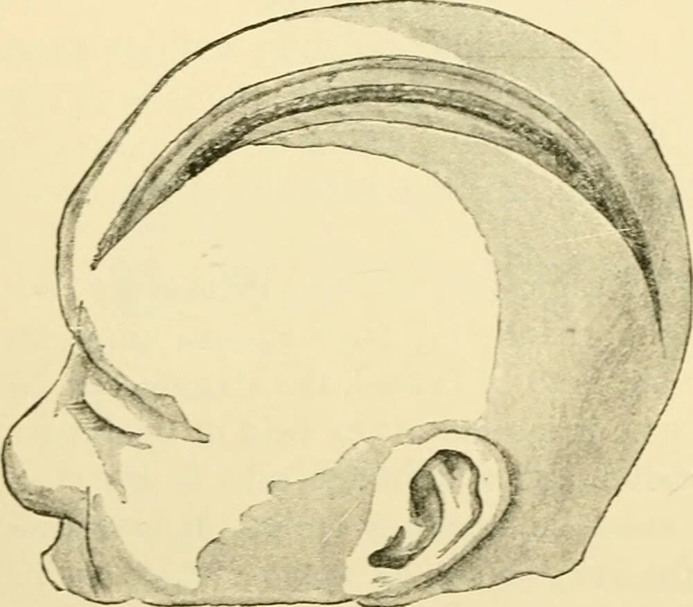 An illustration from Surgical technic; a text-book on operative surgery / by Fr. von Esmarch ... and E. Kowalzig ... translated by Professor Ludwig H. Grau ... and Willam N. Sullivan ... edited by Nicholas Senn ... With fourteen hundred and ninety-seven illustrations and fifteen colored plates., 1901, leaf 538