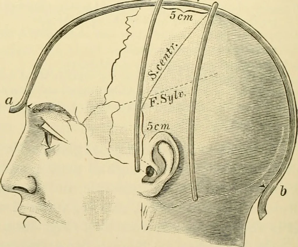 An illustration from Surgical technic; a text-book on operative surgery / by Fr. von Esmarch ... and E. Kowalzig ... translated by Professor Ludwig H. Grau ... and Willam N. Sullivan ... edited by Nicholas Senn ... With fourteen hundred and ninety-seven illustrations and fifteen colored plates., 1901, leaf 542